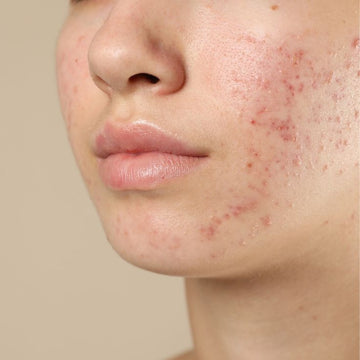 Acne, Oil Control & Pores - Alba Sole