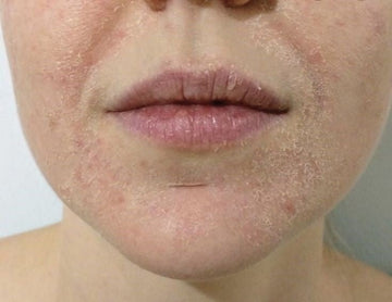 Dry, Dehydrated & Barrier-Damaged Skin - Alba Sole