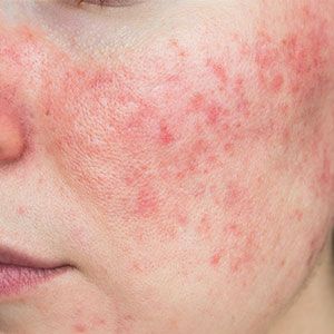 Sensitive & Redness-Prone Skin - Alba Sole